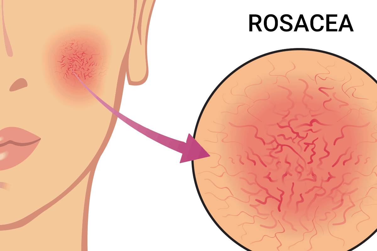 Rosacea: Symptoms, Causes, Treatment, And More.