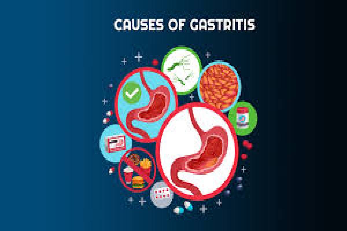 Gastritis What are its Causes and Symptoms Health Bloging