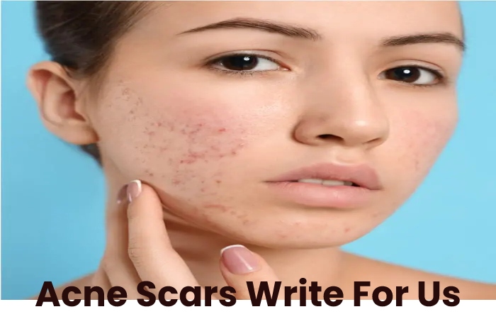 Acne Scars Write For Us