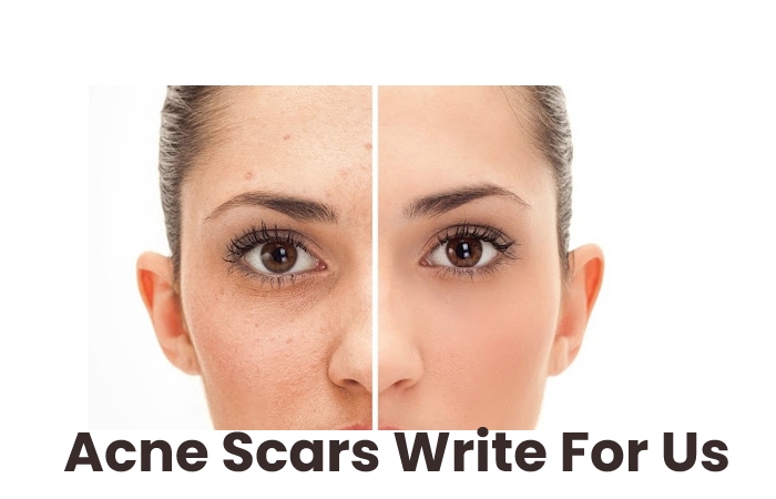 Acne Scars Write For Us