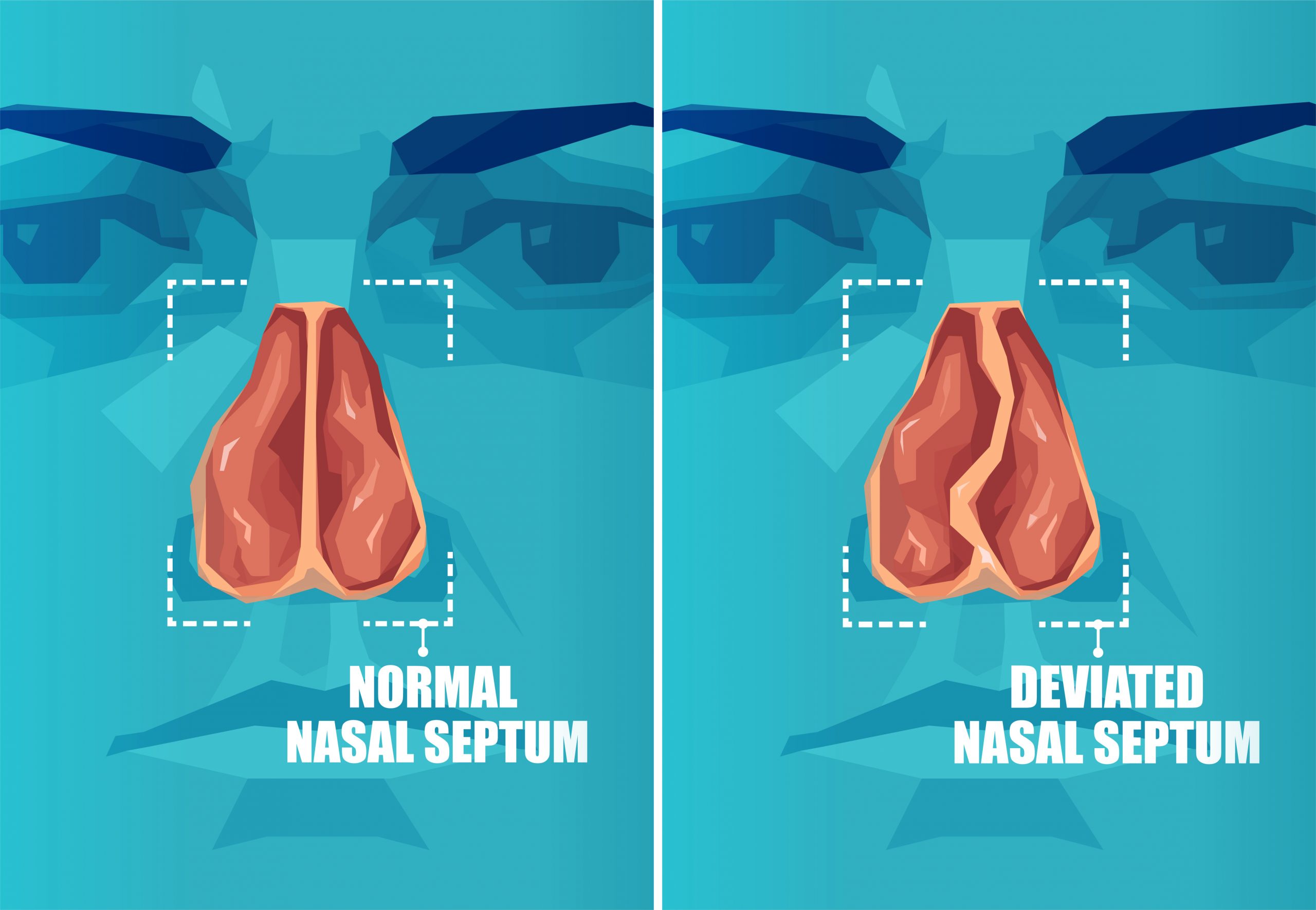 Vector cross section of face with deviated and normal nasal septum