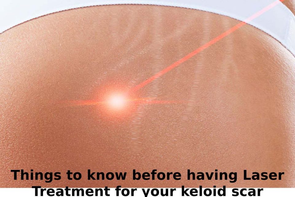 Things to know before having Laser Treatment for your keloid scar