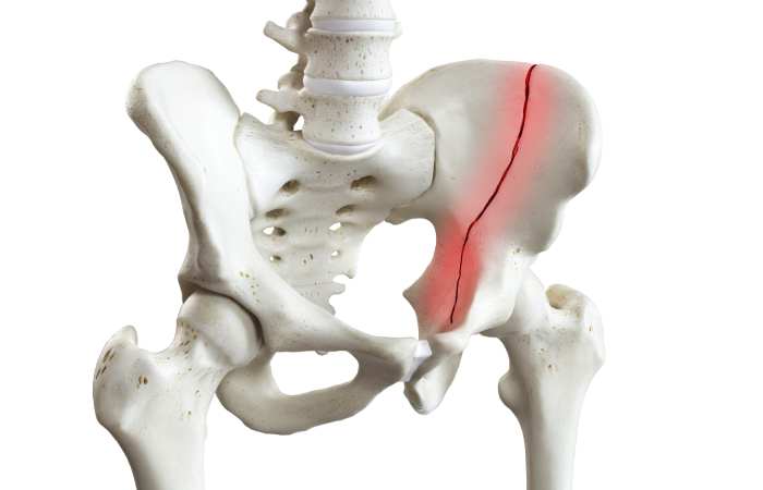 Pelvic Fractures 