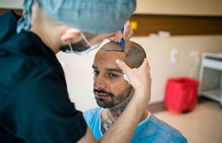 Turkey for a hair transplant