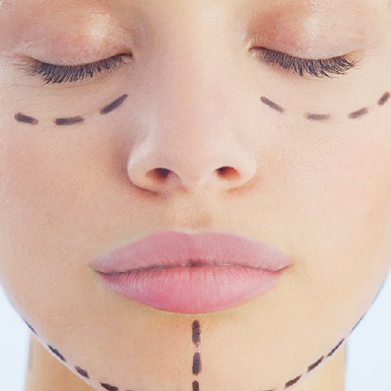 One-Stitch Facelift Vs Thread Lift
