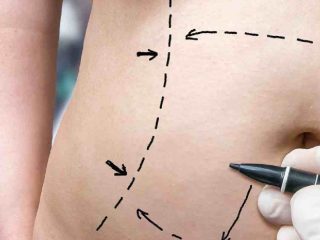 Tummy Tuck Procedure