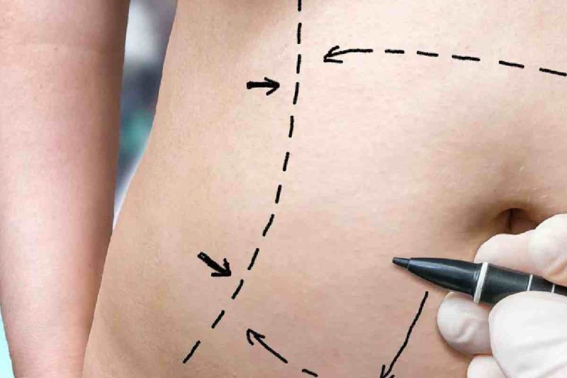 Tummy Tuck Procedure