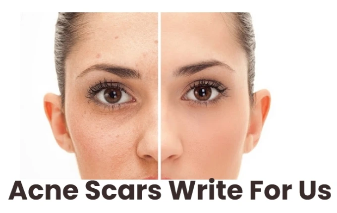Acne Scars Write For Us