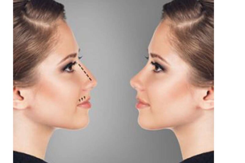 asian nose job procedure