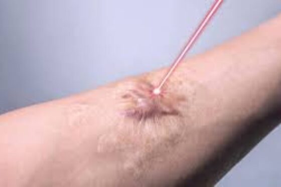 laser treatment for your keloid scar
