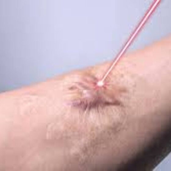 laser treatment for your keloid scar