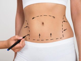 Embracing Transformation Through the Artistry of Liposuction in Tampa, FL