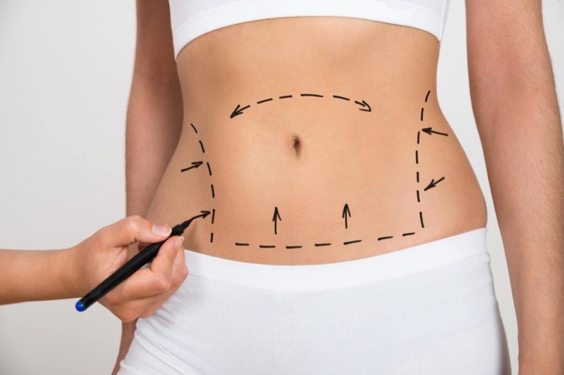 Embracing Transformation Through the Artistry of Liposuction in Tampa, FL