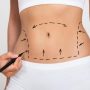 Embracing Transformation Through the Artistry of Liposuction in Tampa, FL
